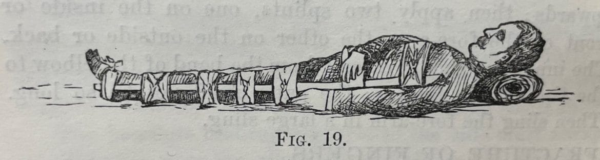 An illustration of the treatment for a fracture of the thigh, using a ‘long splint on the outside of the body, extending from the arm-pit to the foot’.